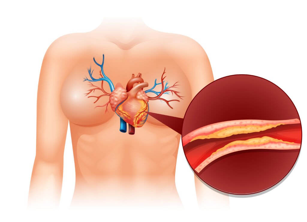 colesterol LDL